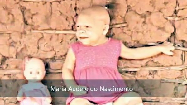Тридцатилетний "младенец" проживает в Бразилии