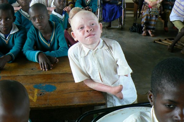 В Танзании альбиносов рубят на куски