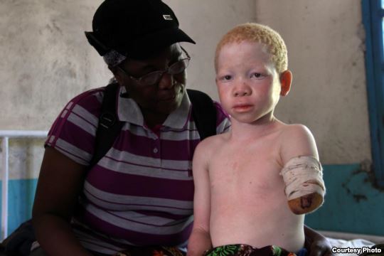В Танзании альбиносов рубят на куски