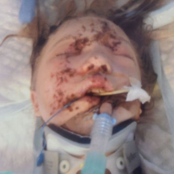 Хирурги сняли лицо девочке, попавшей в аварию, чтобы собрать по частям ее череп