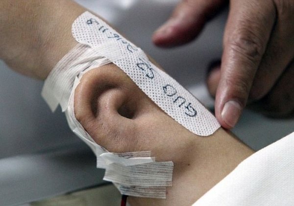 Китайские врачи вырастили ухо на руке пациента