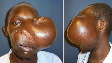 Этому мужчине удалили опухоль на лице размером с голову