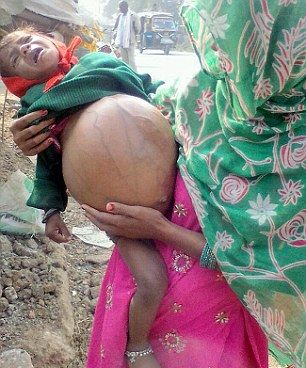 Индийская девочка с огромной опухолью, весящей больше ее тела