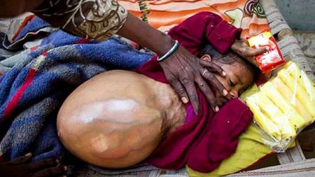 Индийская девочка с огромной опухолью, весящей больше ее тела