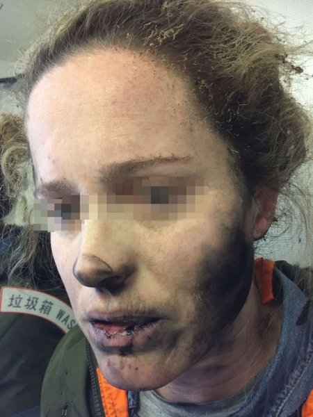 Лицо девушки после взрыва беспроводных наушников