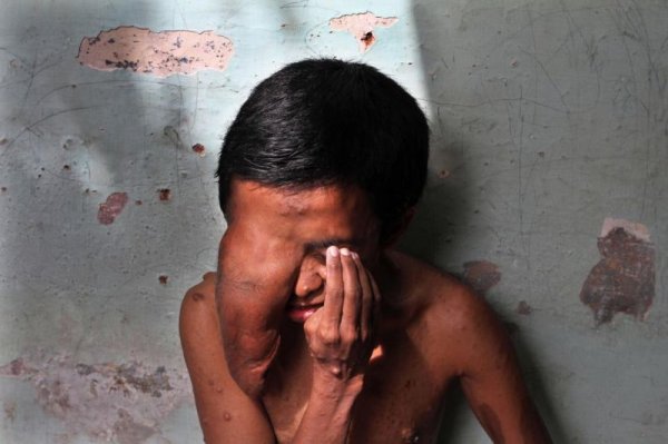Индонезиец страдает от постоянно растущей опухоли на месте глаза
