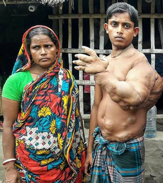 На руке индийского паренька выросла загадочная опухоль