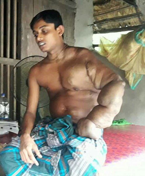 На руке индийского паренька выросла загадочная опухоль