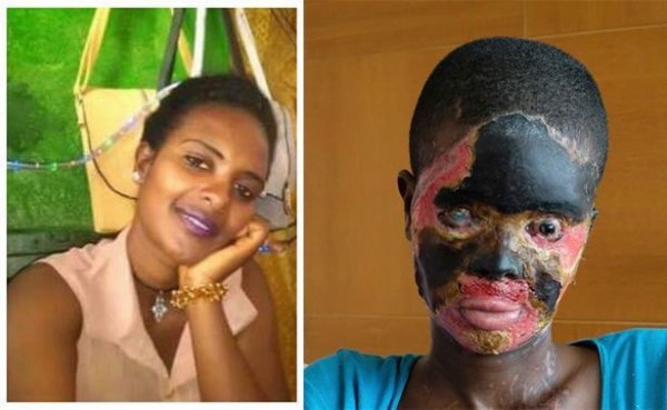 Лицо африканки после того, как муж плеснул ей в лицо кислотой