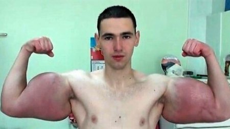 «Хана базукам» Кирилл Терешин из Пятигорска сообщил об удалении рук