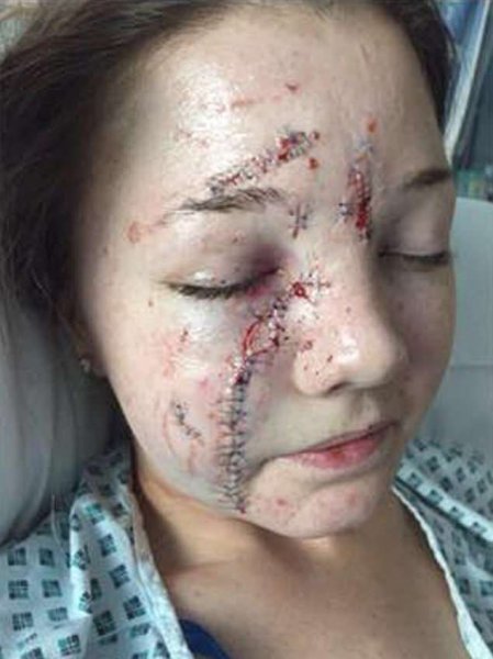 Жуткие шрамы на лице девушки, об голову которой в баре разбили бокал