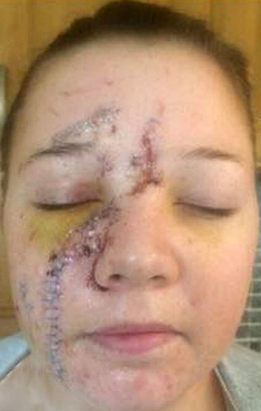Жуткие шрамы на лице девушки, об голову которой в баре разбили бокал
