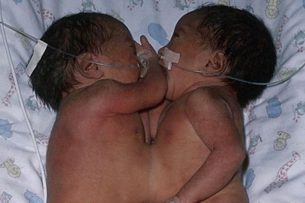 Разделенные сиамские близнецы выросли и превратились в красавиц