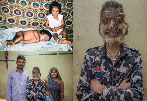 Индийский оборотень, лицо 13-летнего мальчика покрыто волосами