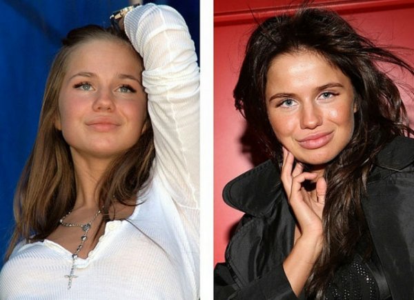 Известные российские красавицы до и после пластики