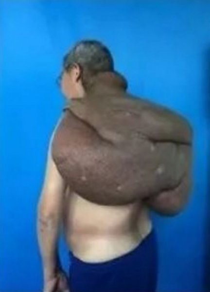 100 хирургов в течение 33 часов срезали со спины китайца раковую опухоль весом 15 кг