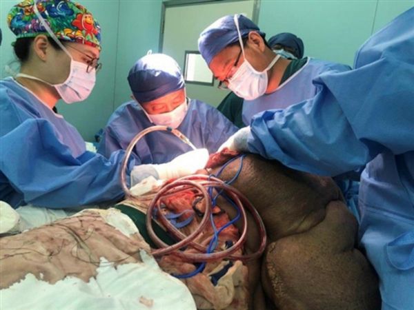 100 хирургов в течение 33 часов срезали со спины китайца раковую опухоль весом 15 кг