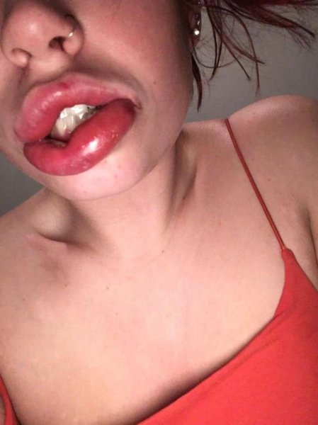 Вместо сексуальных губ девушка получила твердые "сосиски" с гноем