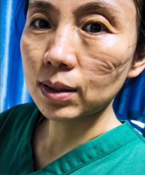 Как выглядят лица врачей после смен в больницах, в которых борются с коронавирусом