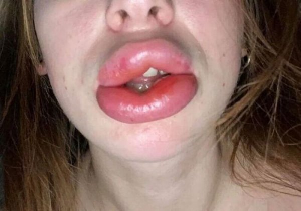 Девушка хотела увеличить губы гелем, но ситуация вышла из-под контроля